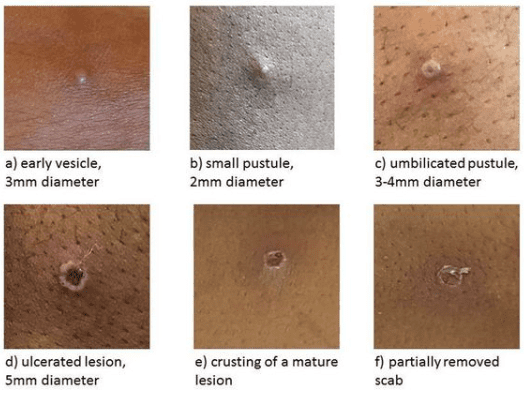 مراحل تطور بثور جدري القرود على الجلد
