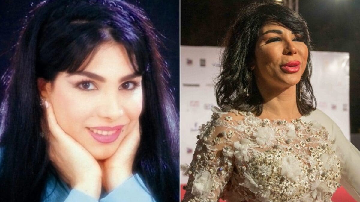 نجمات تشوهن بعد عمليات التجميل
