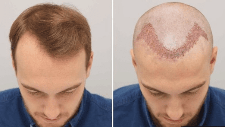 تكلفة زرع الشعر في تركيا بالريال السعودي 