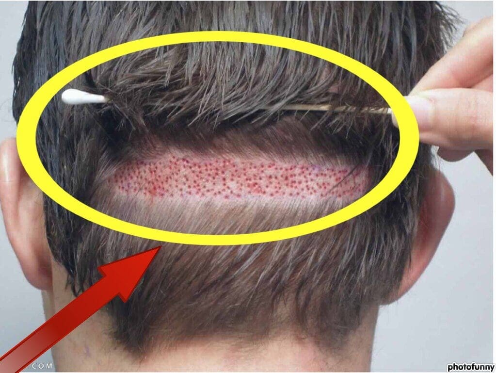 تكلفة زرع الشعر في تركيا بالريال السعودي