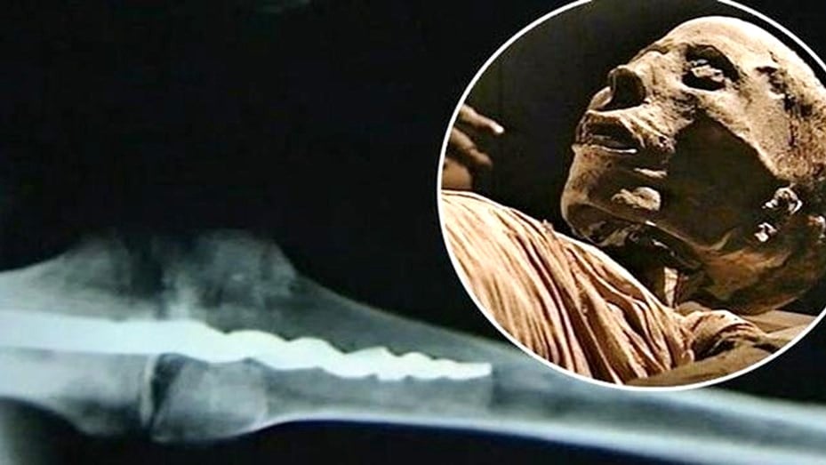 مومياء مصرية تكشف عن أقدم عملية جراحية في التاريخ
