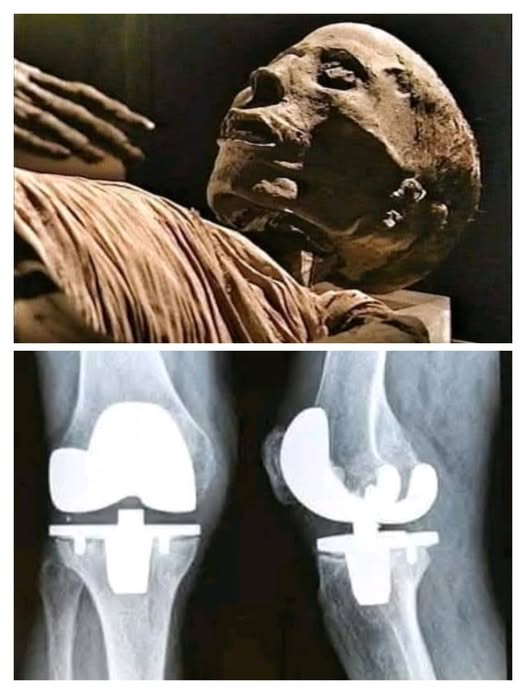 مومياء مصرية تكشف عن أقدم عملية جراحية في التاريخ