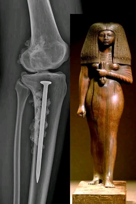 مومياء مصرية تكشف عن أقدم عملية جراحية في التاريخ